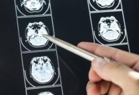The Symptoms of a Brain Injury