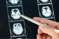 Value of Your Brain Injury Claim?