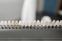 dental-veneers-benefits