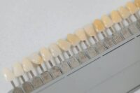 pros-cons-dental-veneers
