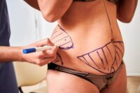 benefits-liposuction-choosing-surgeon.jpg