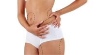 liposuction Targets Persistent Fat.jpg
