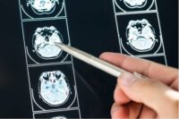 5 Warning Signs of a Brain Injury Most Accident Victims Miss