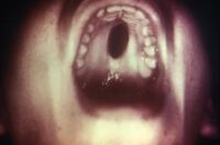 cdc-image-congenital-syphiis-palate