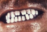 hutchinson's-teeth-congenital-syphilis