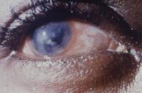 interstitial-corneal-keratitis-congential-syphilis