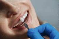Dental Veneers vs. Crowns