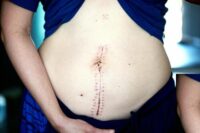 recovering-at-home-after-surgery