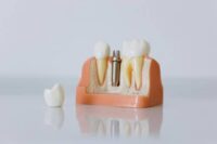 Overhead Costs in Implantology