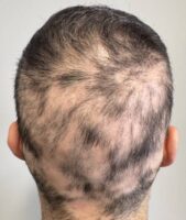 alopecia-areata-dr-king