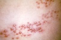 herpes-zoster-cdc-image