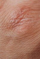 diet-and-psoriasis