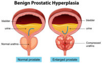 prostate-enlargement-diagram