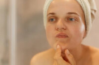 treating-adult-acne-jawline