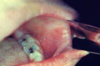 Koplik spots- Measles-CDC image