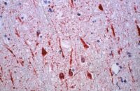 Nipah Virus CNS Infection