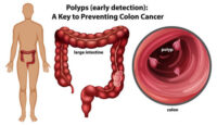 colon-cancer-colonoscopy-diagnosis.jpg