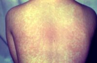 Measles rash: CDC image