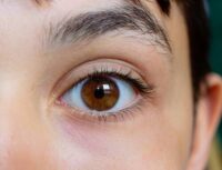 lasix-eye-surgery-and-malpractice.jpg