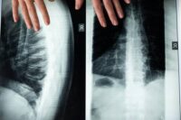 recovery-after-scoliosis-surgery.jpg