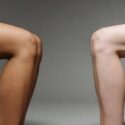 Advances in Minimally Invasive Vein