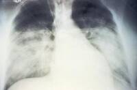 One example of Hanta virus pulmonary disease - CDC image