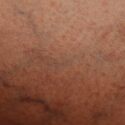how-doctor-chooses-leg-vein-treatment-pexels