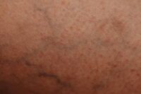 how-doctor-chooses-leg-vein-treatment-pexels