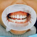 full-mouth-reconstruction-pexels