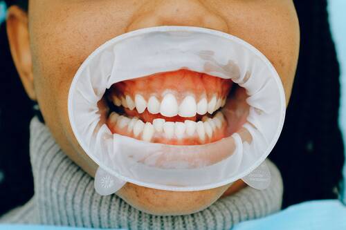 full-mouth-reconstruction-pexels