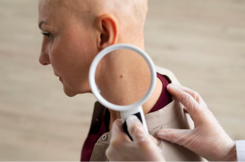 professional-mole-screening-2