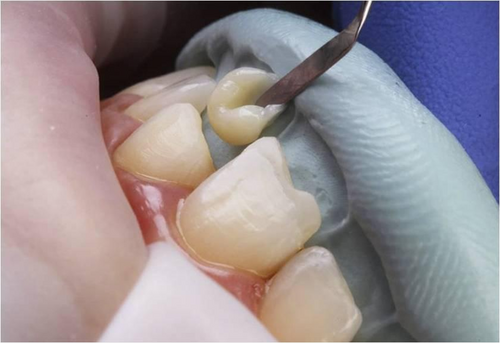 science-behind-tooth-bonding-1