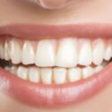 Cosmetic Dentistry Options