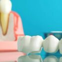 Missing Tooth Needs More Than a Quick Fix