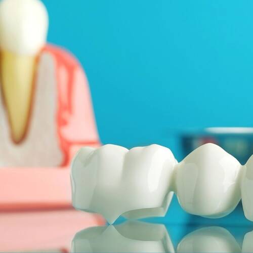Missing Tooth Needs More Than a Quick Fix