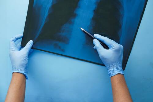 mesothelioma-asbestosis-pexels.jpg