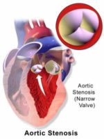 Aortic Stenosis Blaus Image Wikipedia