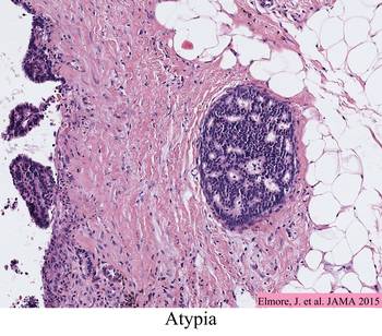 Atypia in Breast Tissue Elmore Image