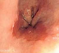 Endometrial cancer amboss. Condyloma acuminata amboss