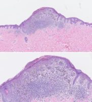 Elmore JG, Barnhill RL, Elder DE, Longton GM, Pepe MS, Reisch LM, Carney PA, Titus LJ, Nelson HD, Onega T, Tosteson ANA, Weinstock MA, Knezevich SR, Piepkorn MW. Pathologists' diagnosis of invasive melanoma and melanocytic proliferations: observer accuracy and reproducibility study. BMJ. 2017 Jun 28;357:j2813. doi: 10.1136/bmj.j2813. Erratum in: BMJ. 2017 Aug 8;358:j3798. PubMed PMID: 28659278; PubMed Central PMCID: PMC5485913.