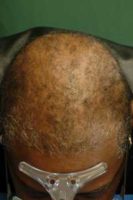 Cicatricial Alopecia Courtesy of Dr. Amy McMichael MD The Department of Dermatology Wake Forest Baptist Medical Center Winston-Salem, North Carolina