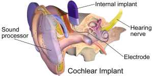 BruceBlaus - Own work An illustration of a cochlear implant.