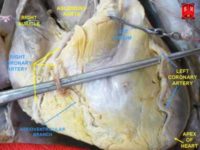 Coronary arteriesAuthor Anatomist90