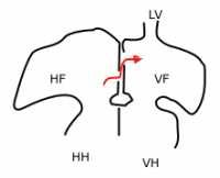 Sketch showing foramen ovale in a fetal heart. Wikipedia image