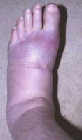 “Gout in my foot” by vagawi  is licensed under CC BY 2.0