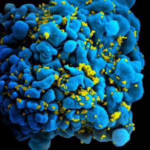 “HIV-infected T cell” by NIAID is licensed under CC BY 2.0