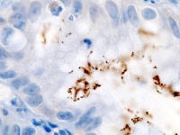 Immunohistochemical staining of H. pylori from a gastric biopsy- Wikipedia image