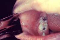 Koplik Spots Early Measles CDC Image