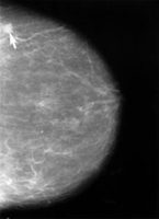Mammogram showing small lesion - Wikipedia