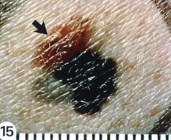 Superficial spreading melanoma arising from a dysplastic nevus